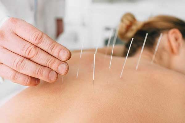 acupuncture