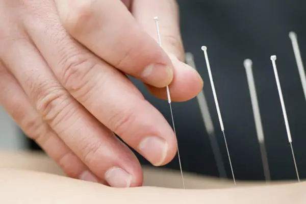 Dry needling a modern acupuncture method for fibromyalgia