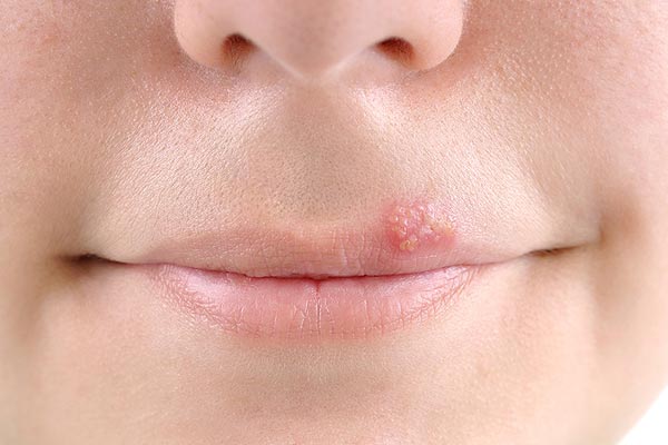 Is Herpes Associated with Fibromyalgia?