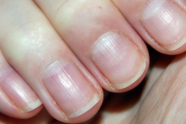 Brittle Nails: Can Fibromyalgia Be Blamed?